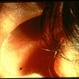 Lyme Disease